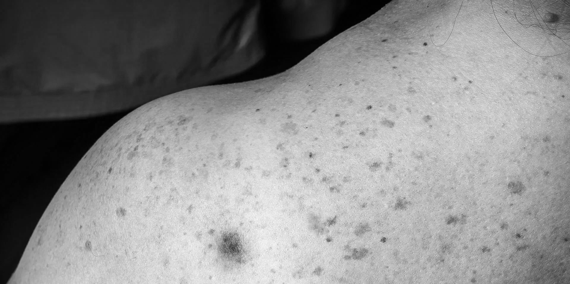 The science of skin cancer – Recognition, risk, and prevention - Bild 2